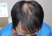 又熬夜又染燙 加速雄性禿