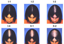 青絲如雲 不再無髮度 女性落髮禿髮問題知多少