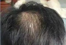 服用禿頭藥物「柔沛」 全身毛髮由黑轉白