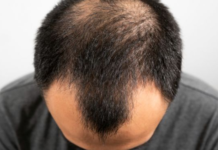 偷吃避孕藥治禿頭 男子乳房膨脹險變性