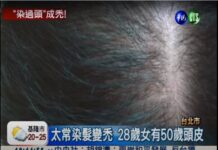 染髮過度傷頭皮 30歲女子禿頭