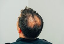 禿頭影響愛情?為愛服藥終成眷屬