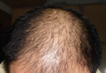 禿頭遺傳自爸爸還是媽媽?醫生告訴你