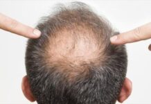 日本開發出再生醫療技術可大量增加頭髮毛囊組織