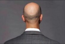 禿頭掉髮救星!骨質疏鬆治療藥物可促進頭髮生長