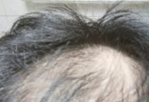 女生真討厭禿頭嗎? 32歲男交友求愛慘被分手