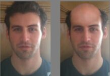 禿頭掉髮的人在愛情交友市場上極為弱勢