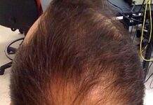 新研究發現禿頭可能被治癒